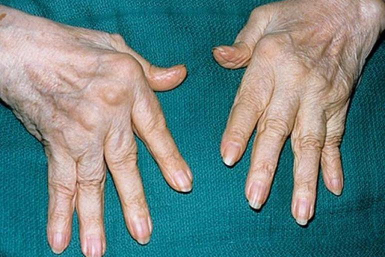 Активный ревматоидный артрит в тяжёлой форме