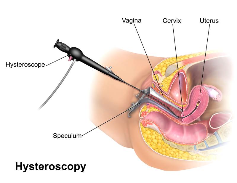 Процедуры выскабливания эндометрия при гиперплазии в менопаузе