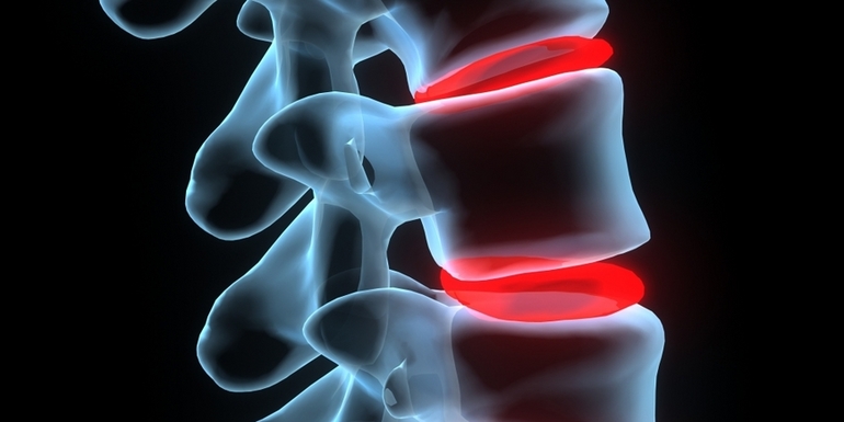 Лечение артроза и остеоартроза рёберно-позвоночных сочленений