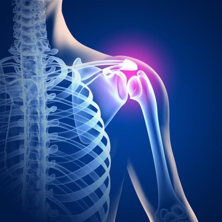 Причины развития артроза плечевого сустава