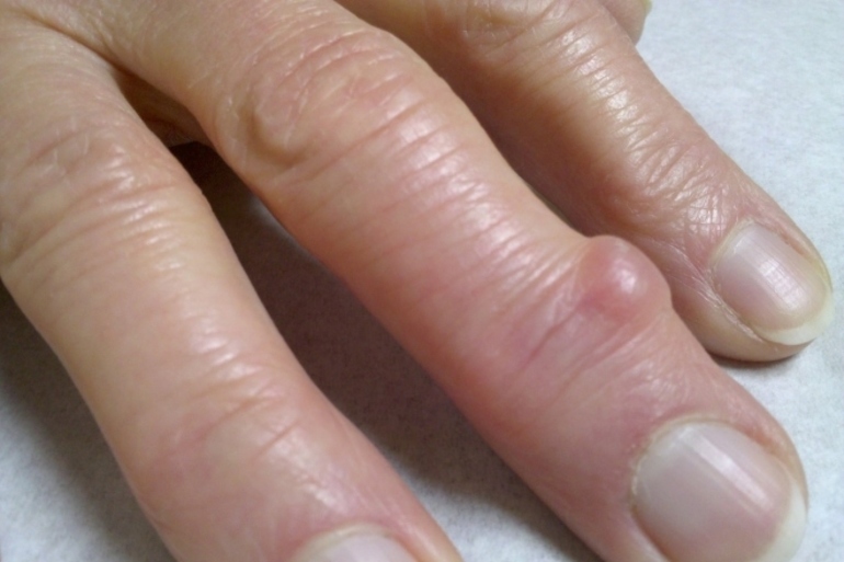 Какими методами лечить шишки на пальцах