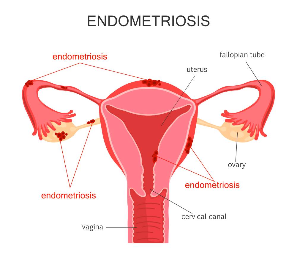 Эндометриоз - симптомы и признаки при климаксе