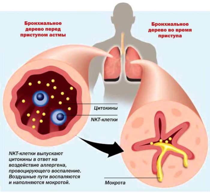 Бронхиальная астма