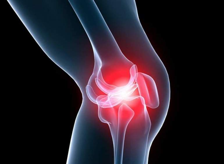 Развитие артроза коленного сустава