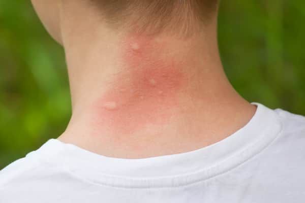 укусы комара на шее