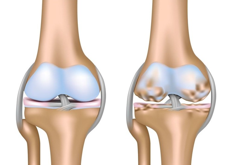  посттравматический артроз коленного сустава 3 степени