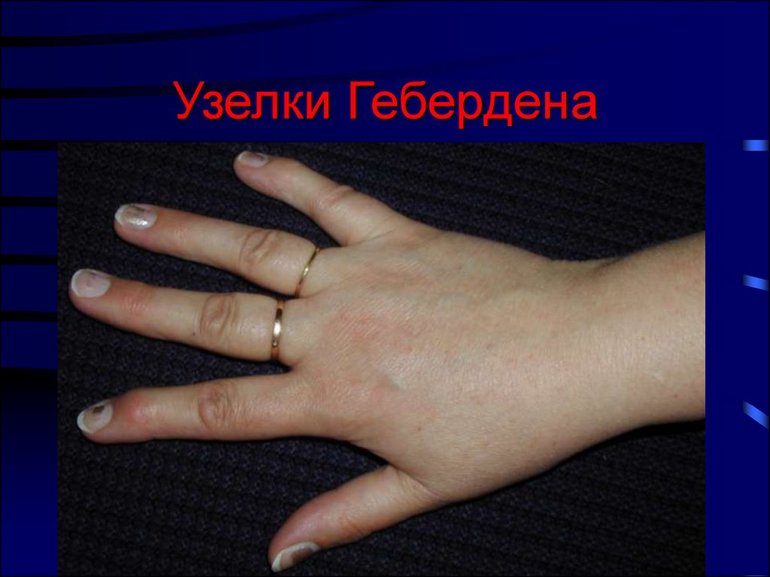 Причины появления шишек на пальцах рук