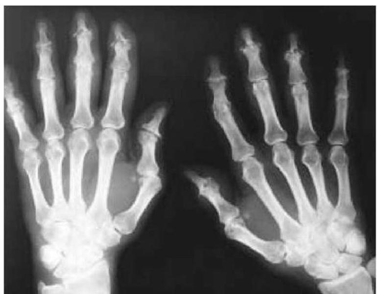 Рентген кисти рук