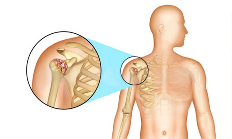 Как быть при диагнозе артроз плечевого сустава 