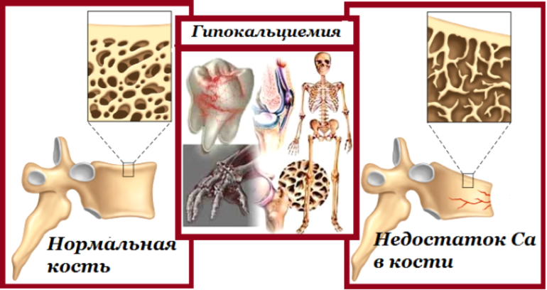 Недостаток кальция в костях. Кальций в костях. Проявления гипокальциемии. Гипокальциемия симптомы. Гипокальциемия картинки.