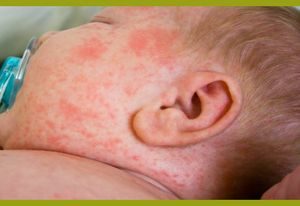 Аллергия на малыше