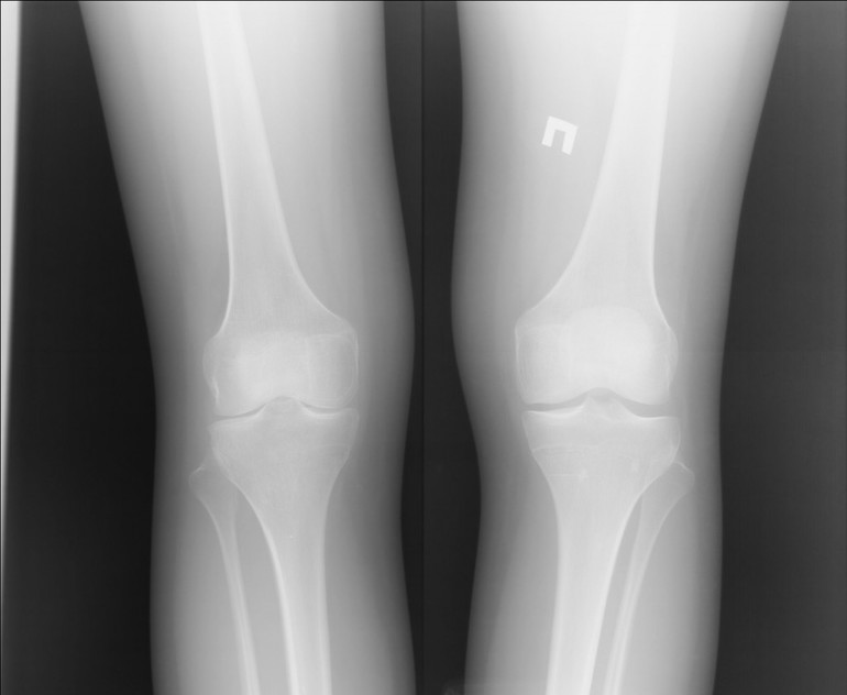 Как подговиться к рентгену коленного сустава