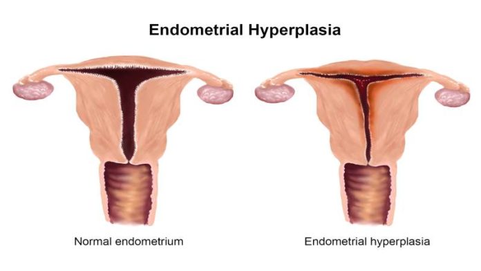 Выскабливание при гиперплазии эндометрия в постменопаузе - эффективность и отзывы