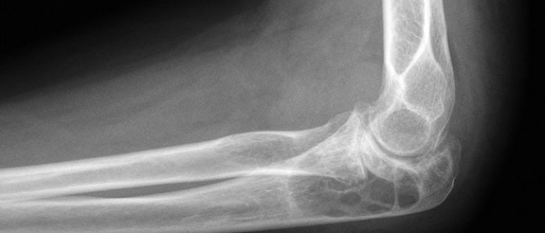 Рентгенограмма локтевого сустава
