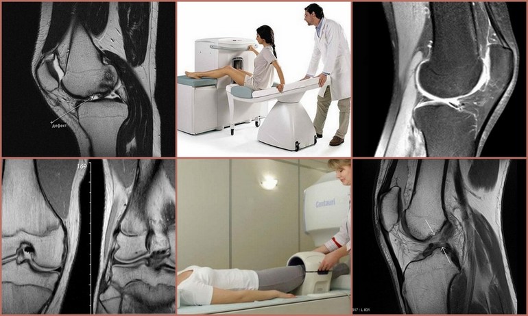 Какие поражения тканей показывает УЗИ коленного сустава