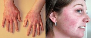 аллергическая сыпь на руках и лице