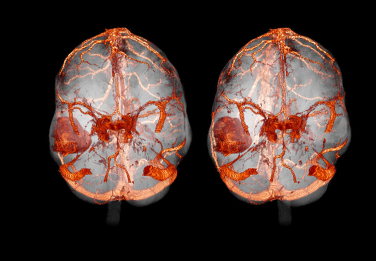 Снимок сосудов головного мозга