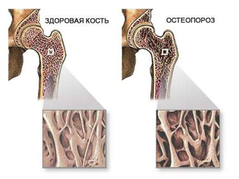 Как быть при диагнозе остеопороз